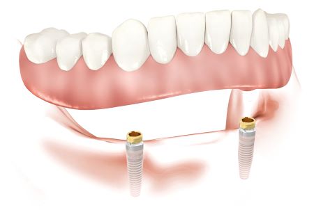prothèse mandibulaire stabilisée sur 2 implants