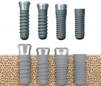 Des implants dentaires
