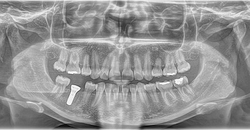 radiographie d'un implant