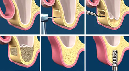 image décrivant le principe du sinus-lift
