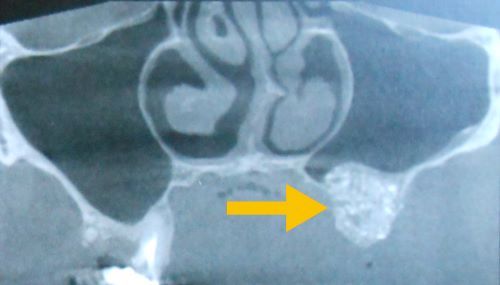 radiographie d'un sinus lift