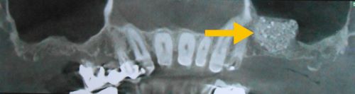 radiographie d'un sinus lift